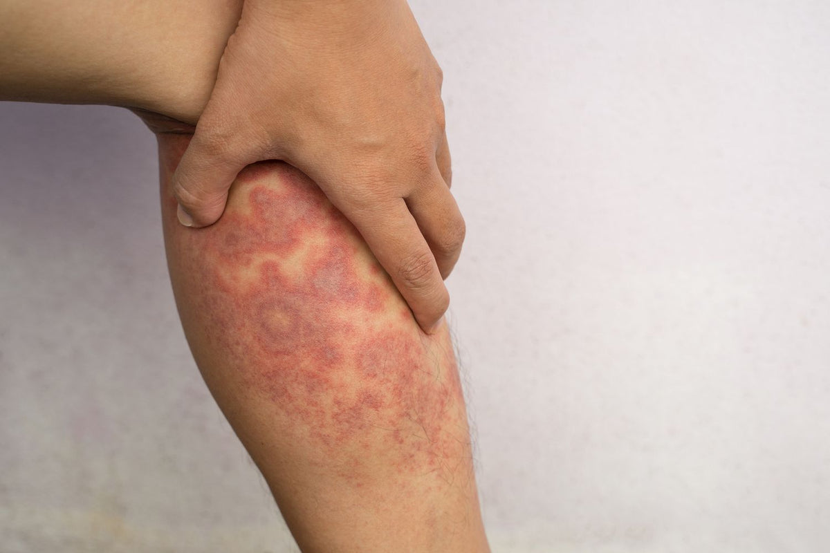 Understanding Eczema: Causes, Symptoms, and Natural Remedies