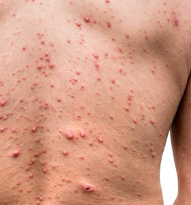 Natural Remedies for Chickenpox: The Power of Essential Oils