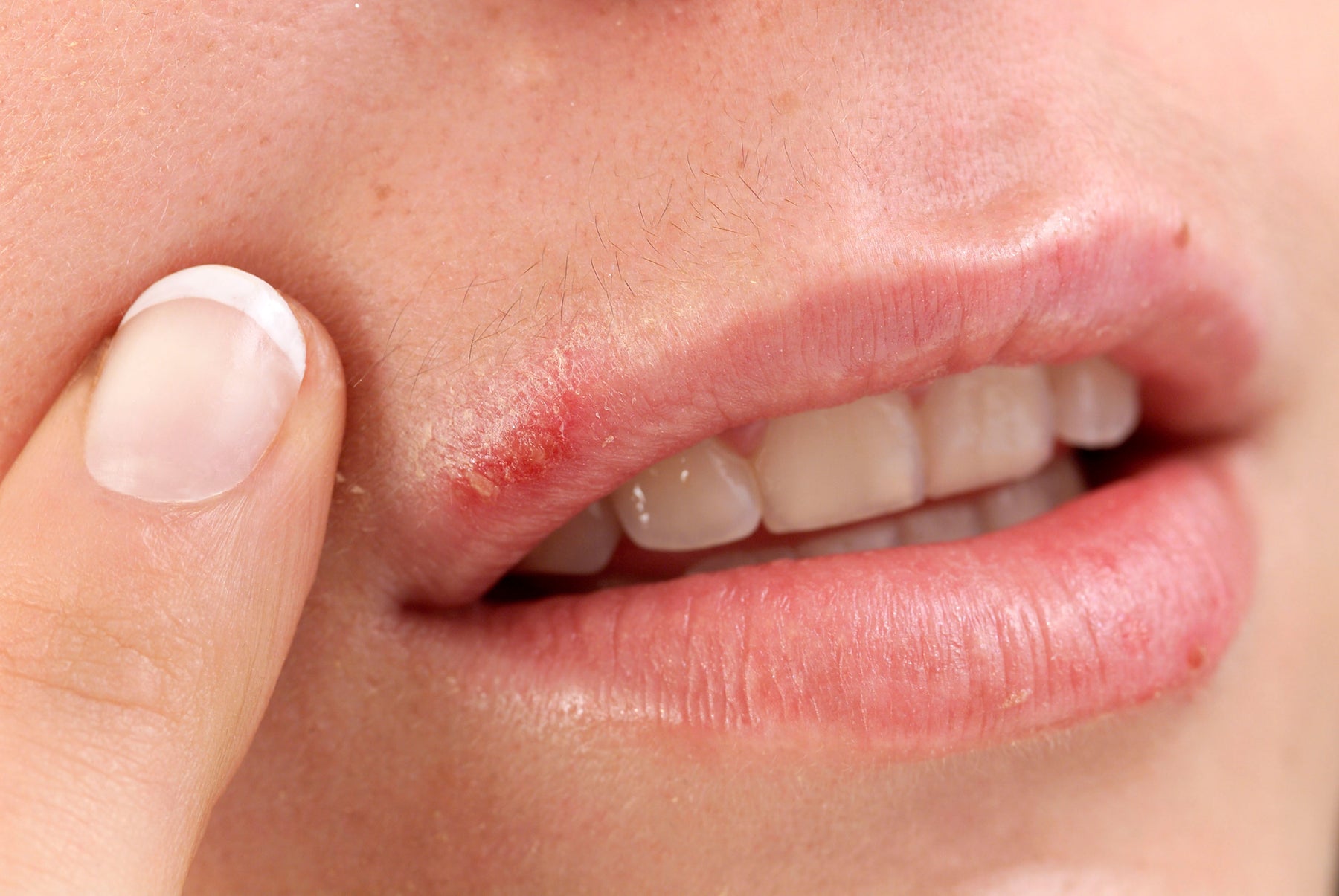 Natural Remedies for Cold Sores: The Power of Essential Oils