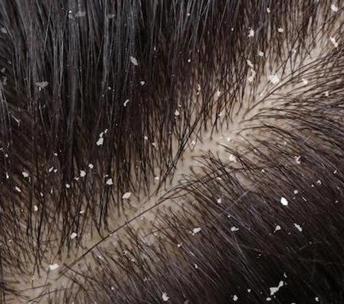 Natural Aromatherapy Solutions: Combat Dandruff Effectively with Essential Oils