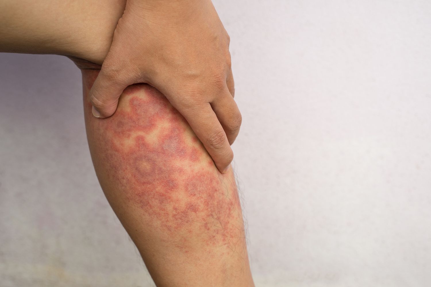 Understanding Eczema: Causes, Symptoms, and Natural Remedies