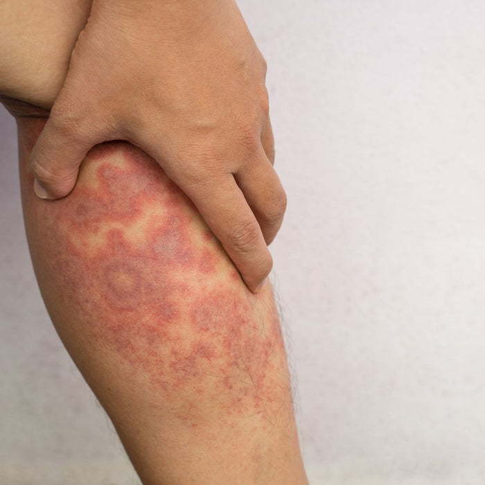 Understanding Eczema: Causes, Symptoms, and Natural Remedies