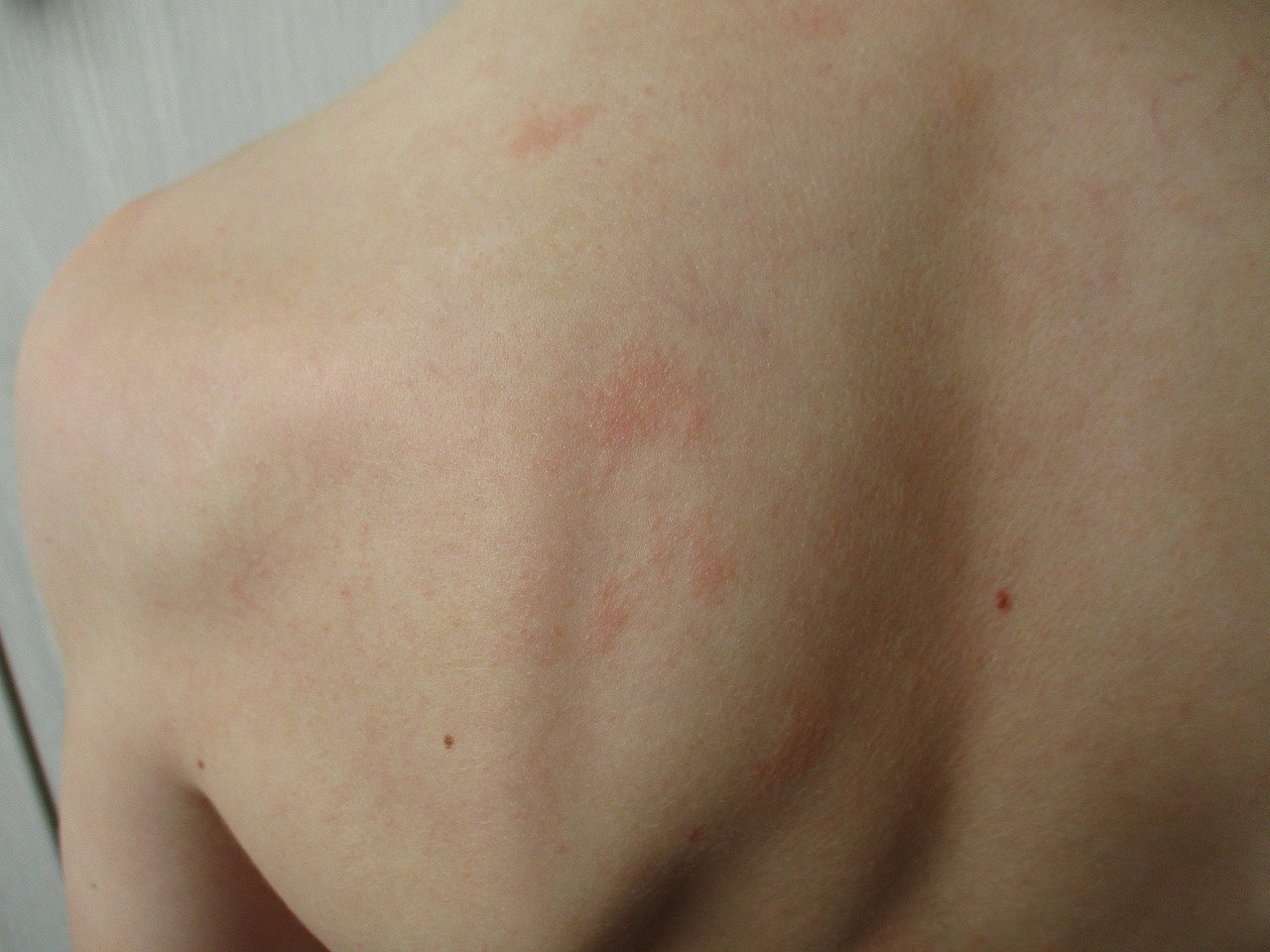 Skin allergies and essential oils