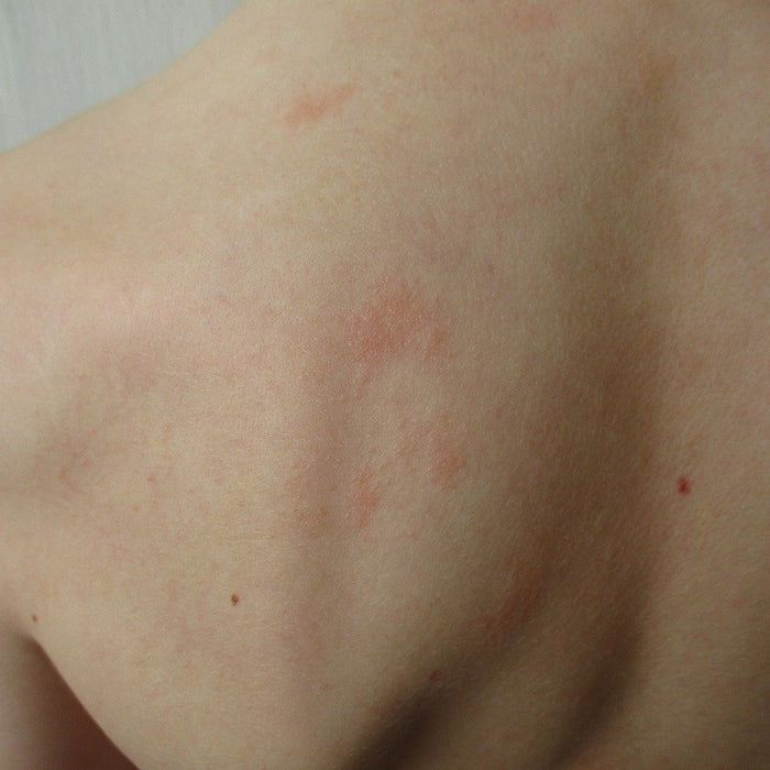 Skin allergies and essential oils