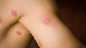 Natural Remedies for Skin Infections: Understanding Boils, Whitlow, and Impetigo