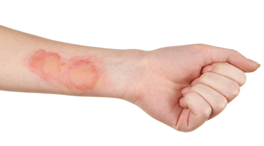 Natural Remedies for Common Skin Infections: Essential Oils to the Rescue