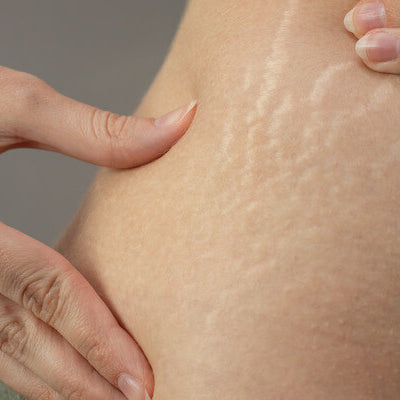 Natural Solutions for Stretch Marks: Essential Oils and Vegetable Oils to the Rescue