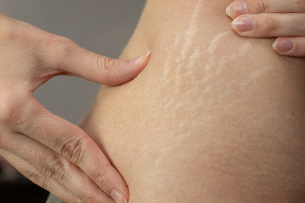 Natural Solutions for Stretch Marks: Essential Oils and Vegetable Oils to the Rescue